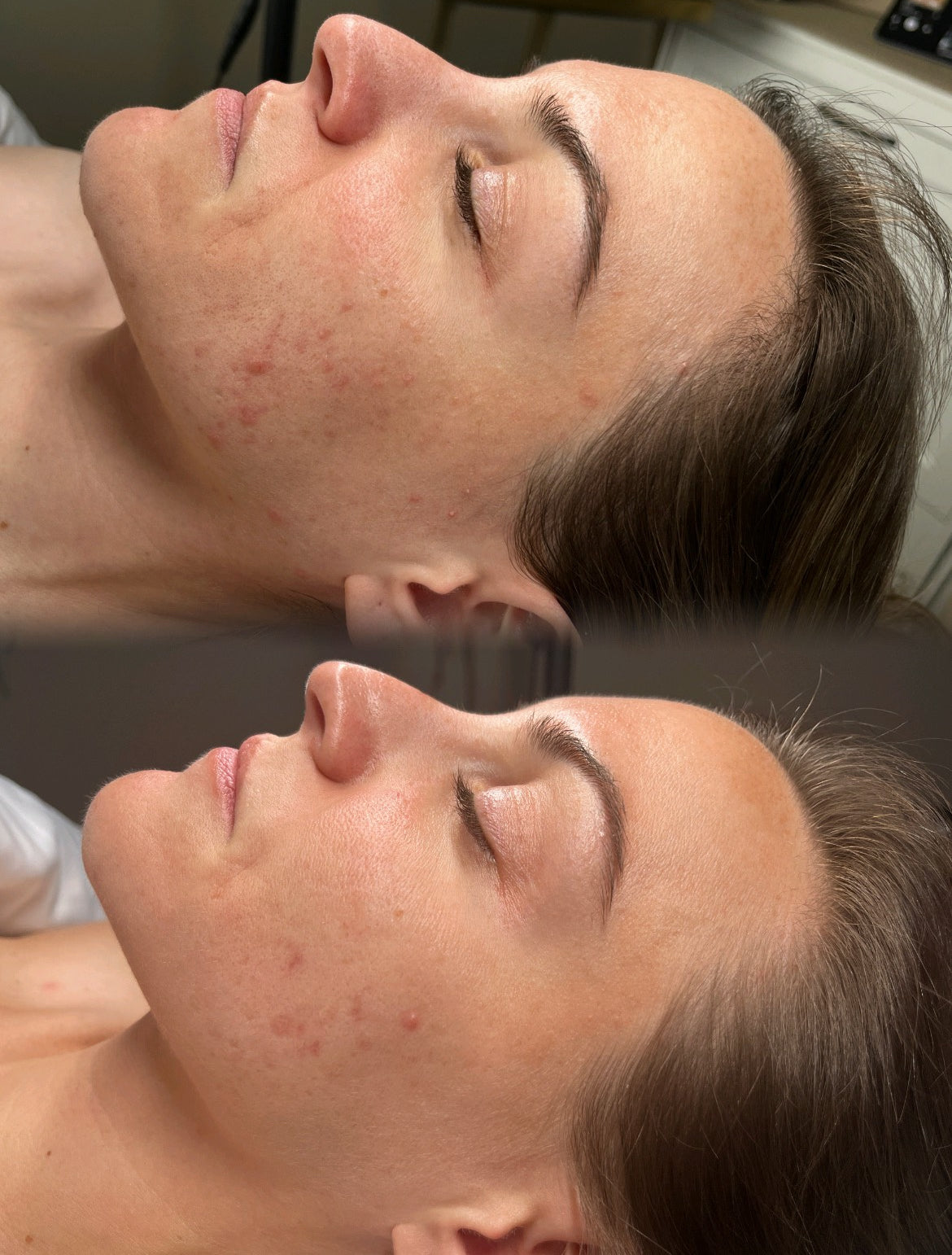 3 Face Reality Acne Treatments