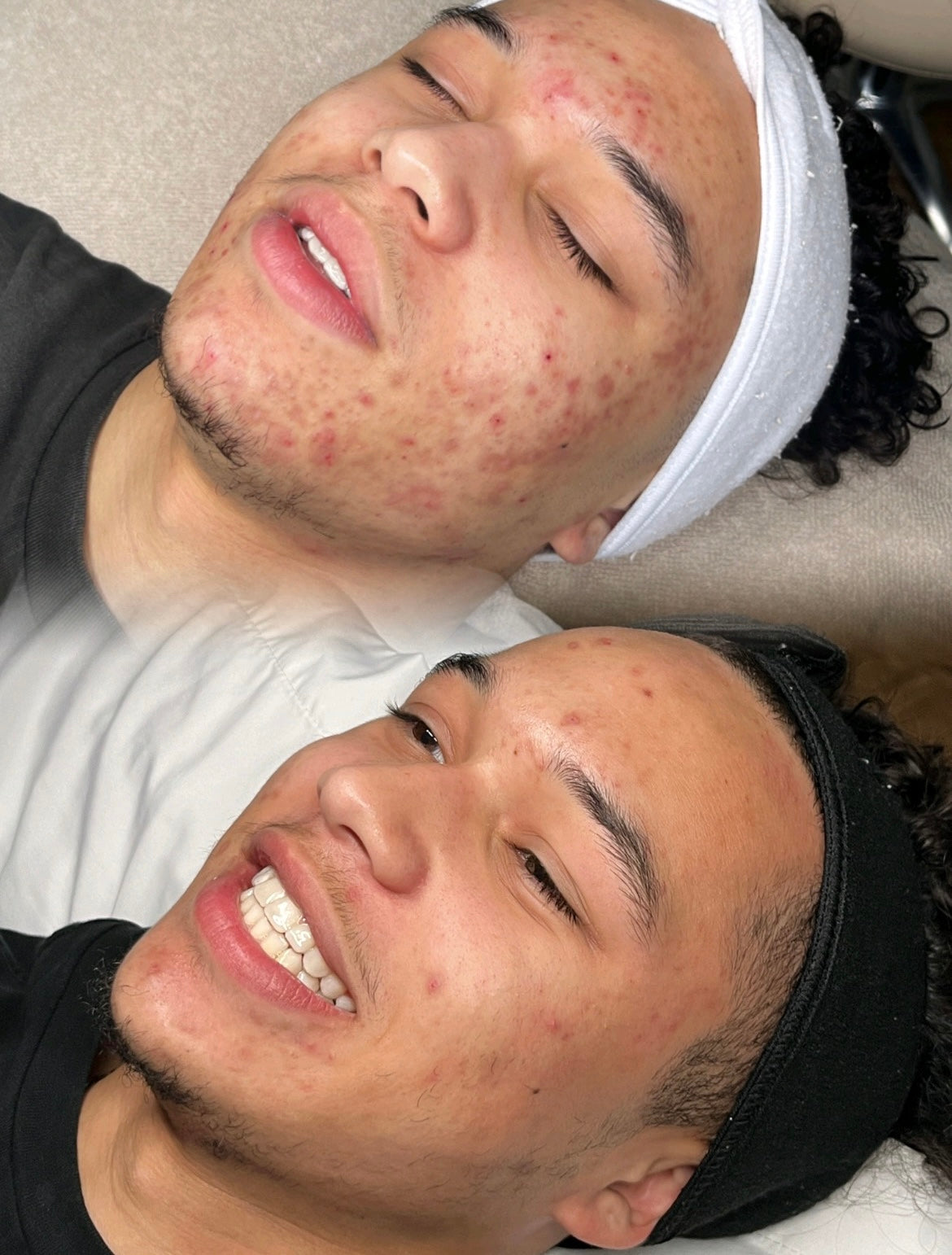 Face Reality 3 Month Acne Program