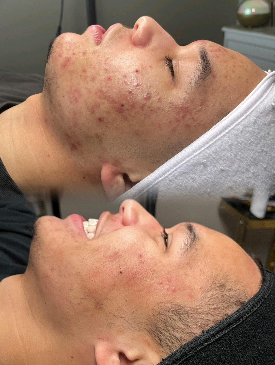 Face Reality 3 Month Acne Program