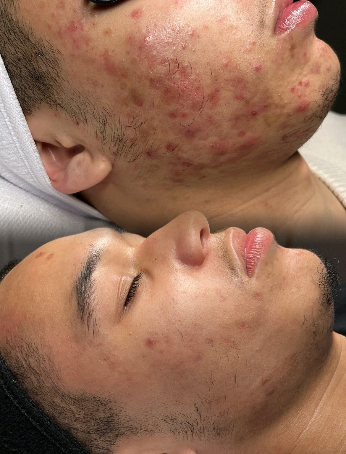 Face Reality 3 Month Acne Program